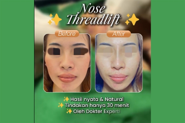 Mimpi punya hidung mancung tapi takut operasi?